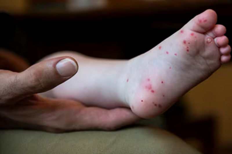 Cegah Penularan Flu Singapura, Begini Cara Pencegahannya