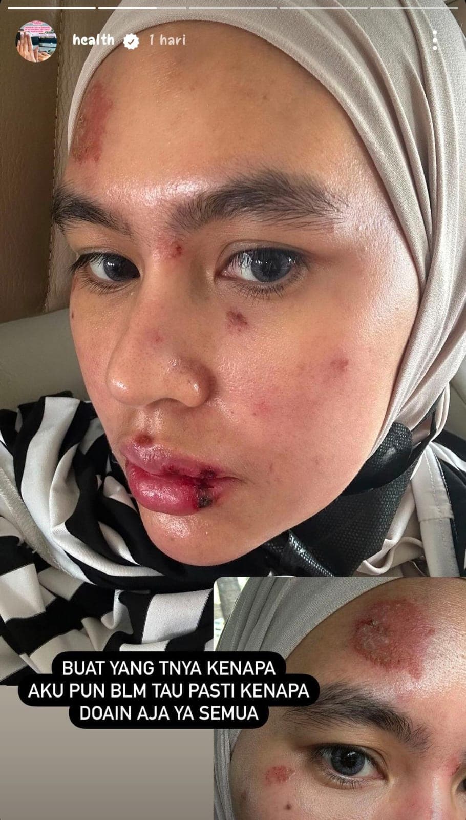 Wajah Kartika Putri yang mengalami ruam. (Tangkap layar akun IG @kartikaputriworld)