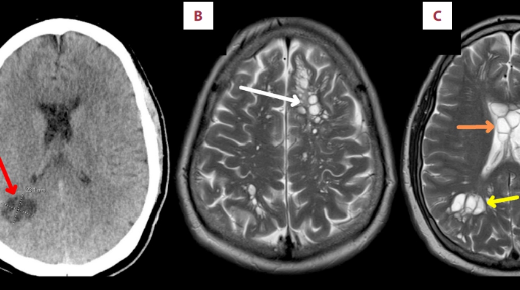 Cacing pita bersarang di otak sang pria. (Dokumen American Journal of Case Report)